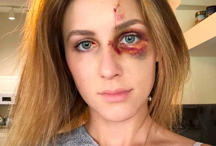 Frappée au visage par son petit ami, elle partage les photos sur Instagram !