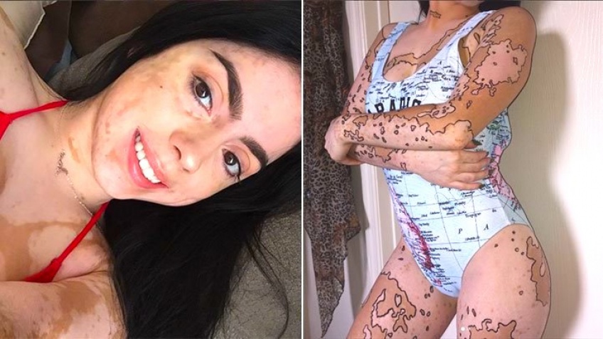 Elle dessine par dessus son vitiligo et prend part au mouvement body positiv