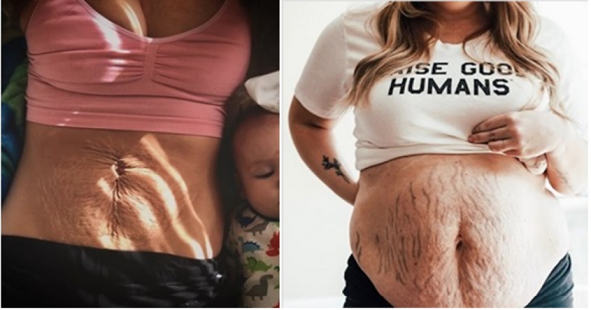 Body Positive : ces femmes dévoilent fièrement leurs corps après la grossesse !