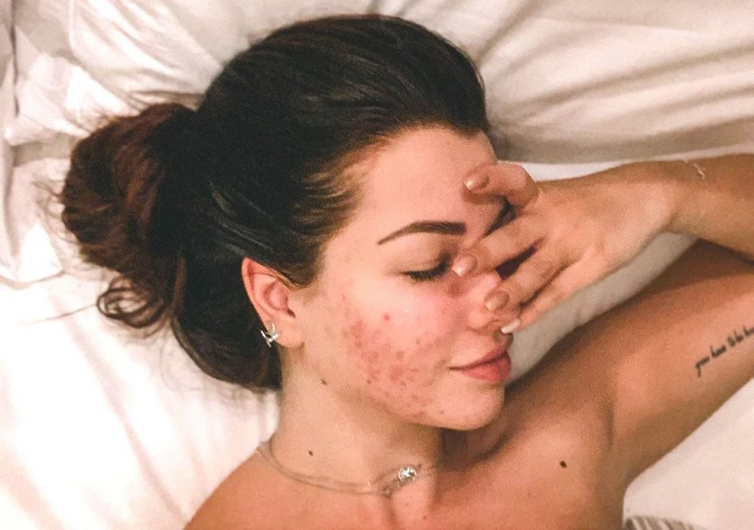 #BodyGlory : EnjoyPhoenix, la youtubeuse qui expose son acné sans filtre !