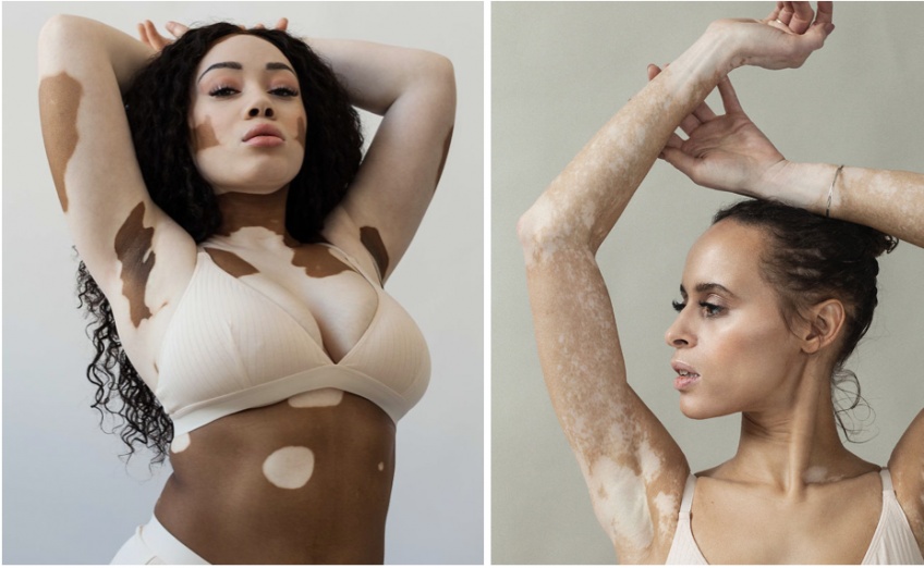 Elle photographie des femmes atteintes comme elle de Vitiligo !