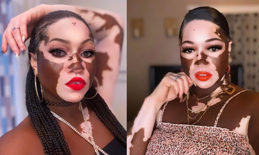 #BodyGlory : Une maman atteinte de Vitiligo devient modèle photo