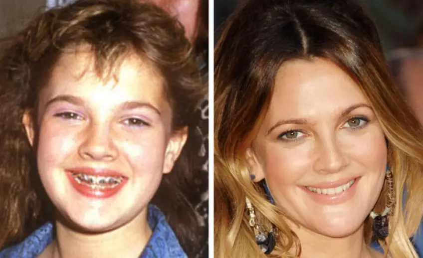 Les transformations dentaires les plus spectaculaires des célébrités