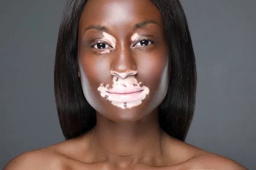 Body Glory : Atteinte de vitiligo, Estelle raconte comment elle a appris à s'aimer !