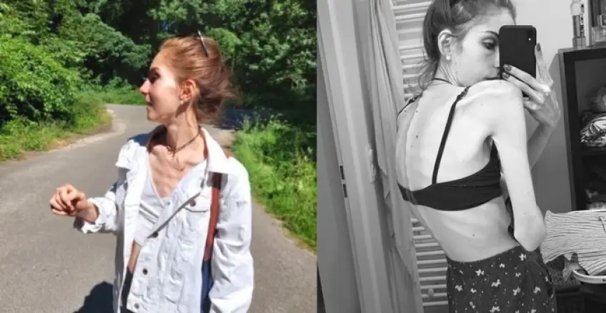 Body Glory : Atteinte d'anorexie, Mathilde partage son histoire et comment elle vit son poids !