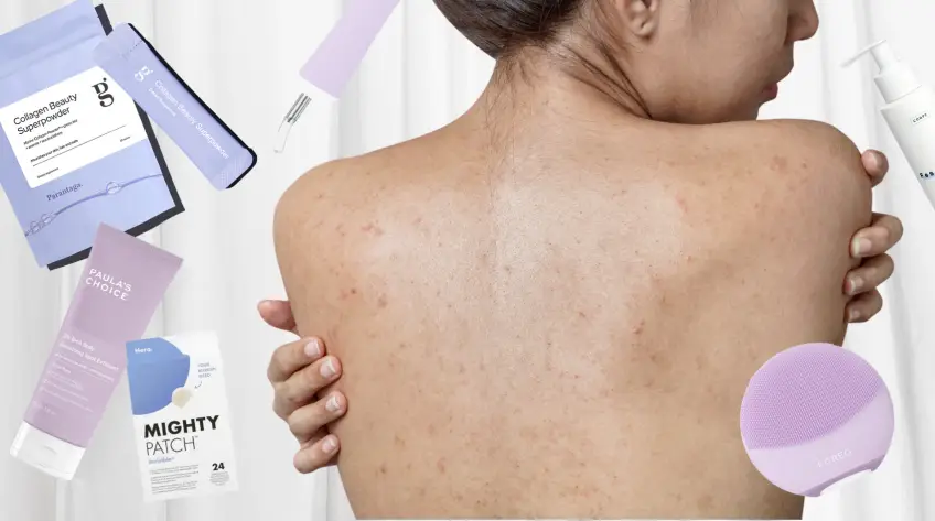 L'acné corporelle : une problématique qui touche de plus en plus les femmes